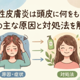 脂漏性皮膚炎は頭皮に何をもたらす?その主な原因と対処法を解説